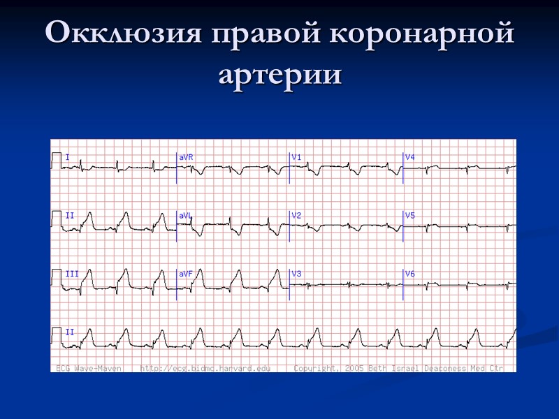 Окклюзия правой коронарной артерии